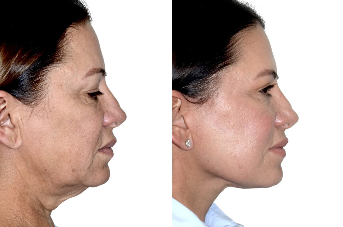 Deep Plane Facelift Before and After Photos in Miami, FL, Patient 30072