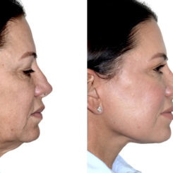 Deep Plane Facelift Before and After Photos in Miami, FL, Patient 30072