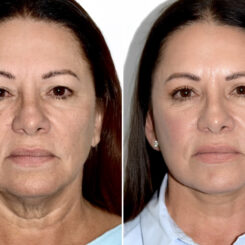 Deep Plane Facelift Before and After Photos in Miami, FL, Patient 30072