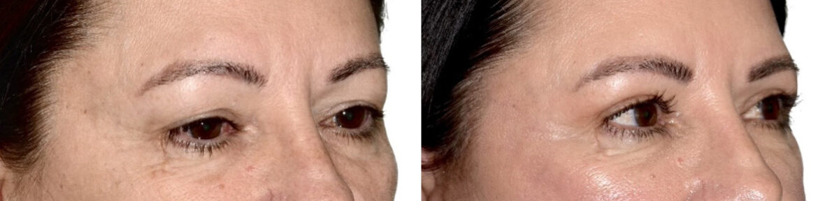 Blepharoplasty (eyelids) Before and After Photos in Miami, FL, Patient 30082
