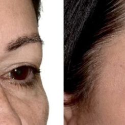 Blepharoplasty (eyelids) Before and After Photos in Miami, FL, Patient 30082