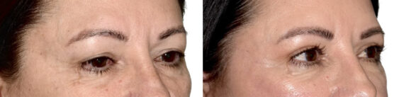 Blepharoplasty (eyelids) Before and After Photos in Miami, FL, Patient 30082