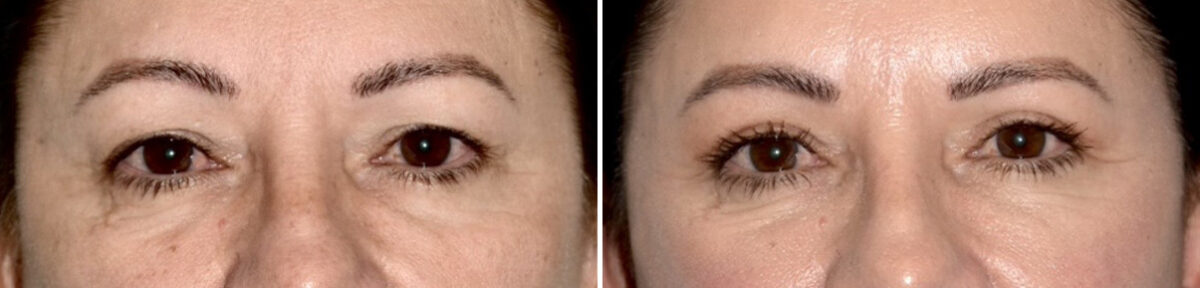 Blepharoplasty (eyelids) Before and After Photos in Miami, FL, Patient 30082