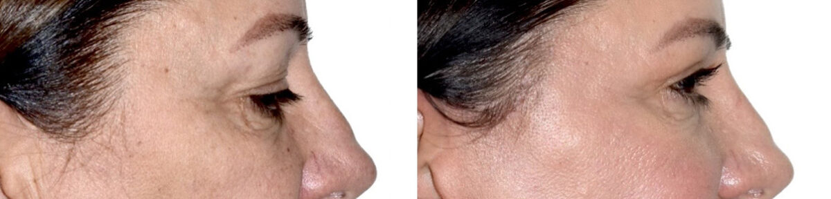 Blepharoplasty (eyelids) Before and After Photos in Miami, FL, Patient 30082