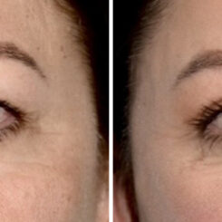 Blepharoplasty (eyelids) Before and After Photos in Miami, FL, Patient 30082