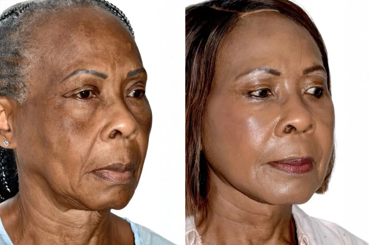 Deep Plane Facelift Before and After Photos in Miami, FL, Patient 30093