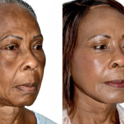 Deep Plane Facelift Before and After Photos in Miami, FL, Patient 30093