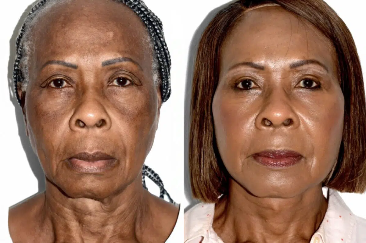 Deep Plane Facelift Before and After Photos in Miami, FL, Patient 30093