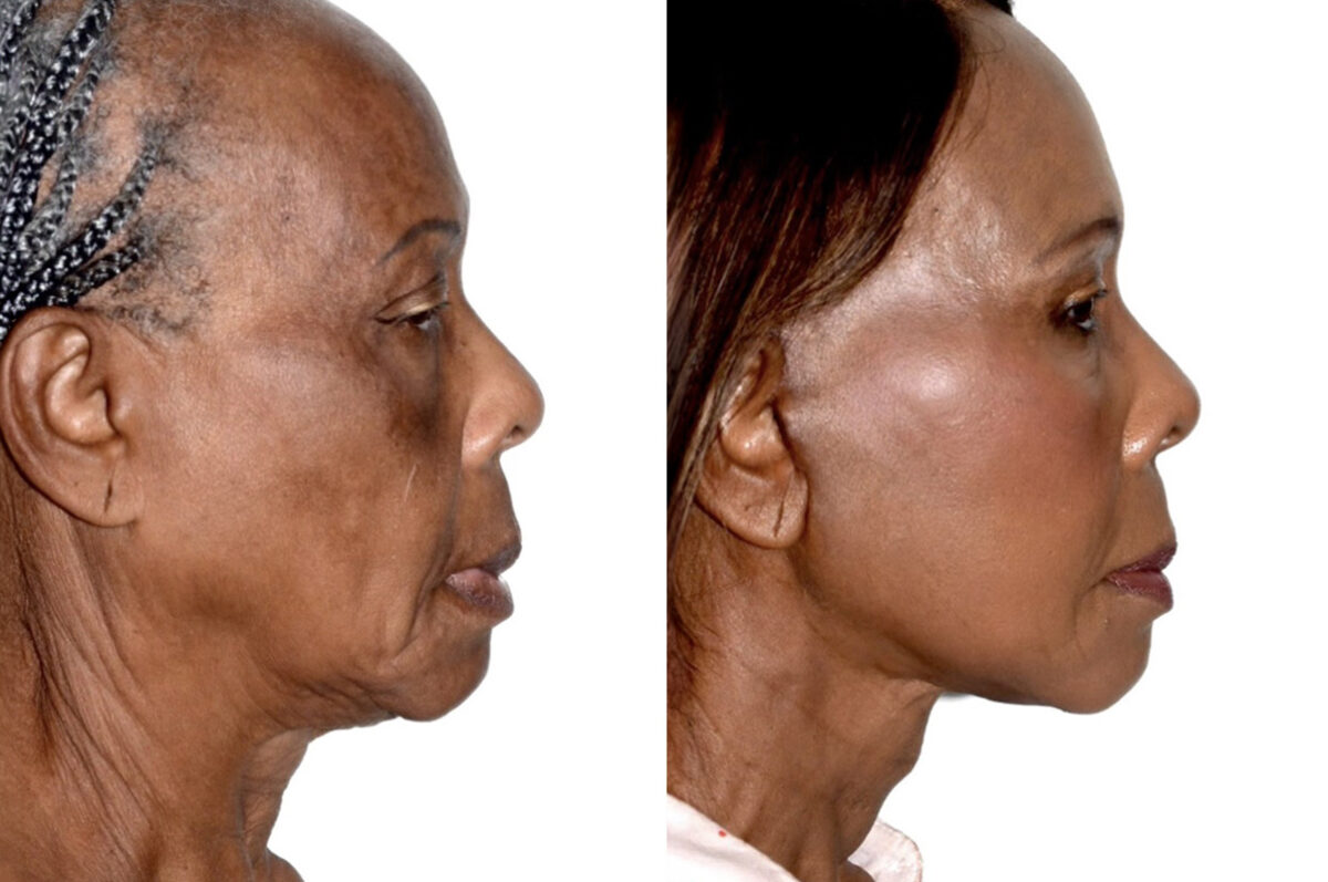 Deep Plane Facelift Before and After Photos in Miami, FL, Patient 30093