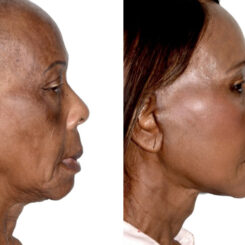 Deep Plane Facelift Before and After Photos in Miami, FL, Patient 30093
