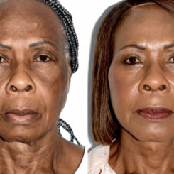 Deep Plane Facelift Before and After Photos in Miami, FL, Patient 30093