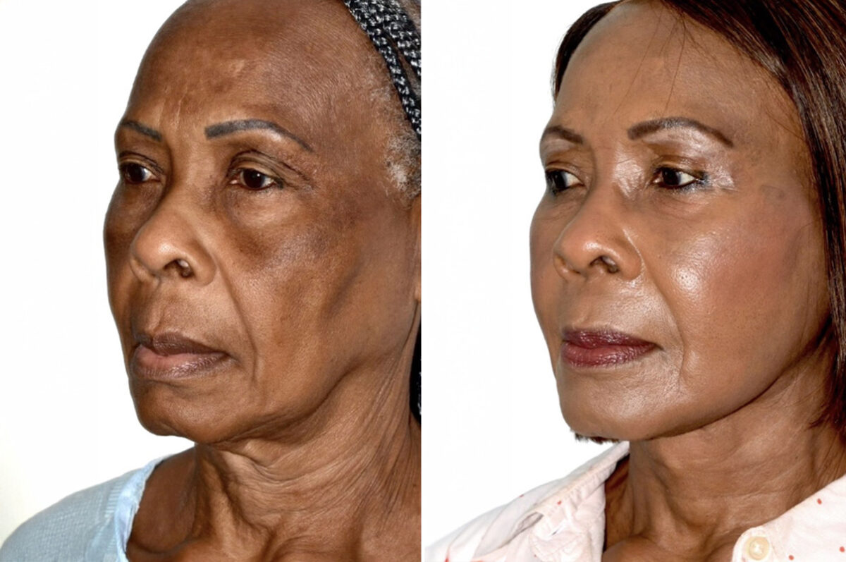 Deep Plane Facelift Before and After Photos in Miami, FL, Patient 30093