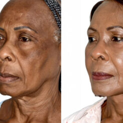 Deep Plane Facelift Before and After Photos in Miami, FL, Patient 30093