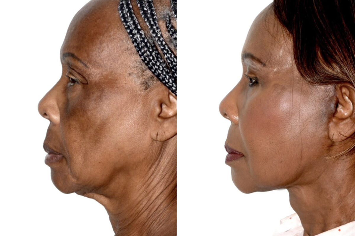 Deep Plane Facelift Before and After Photos in Miami, FL, Patient 30093