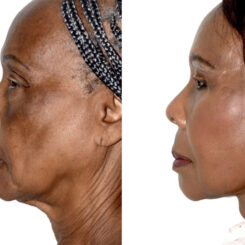 Deep Plane Facelift Before and After Photos in Miami, FL, Patient 30093