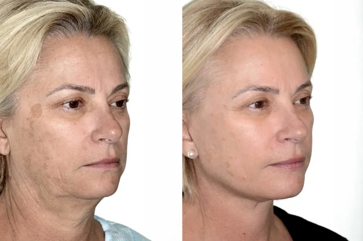 Deep Plane Facelift Before and After Photos in Miami, FL, Patient 30110