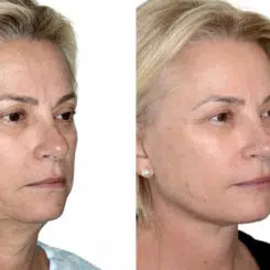 Deep Plane Facelift Before and After Photos in Miami, FL, Patient 30110