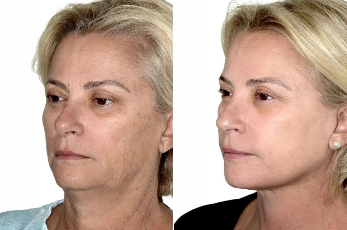 Deep Plane Facelift Before and After Photos in Miami, FL, Patient 30110