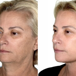 Deep Plane Facelift Before and After Photos in Miami, FL, Patient 30110
