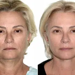 Deep Plane Facelift Before and After Photos in Miami, FL, Patient 30110
