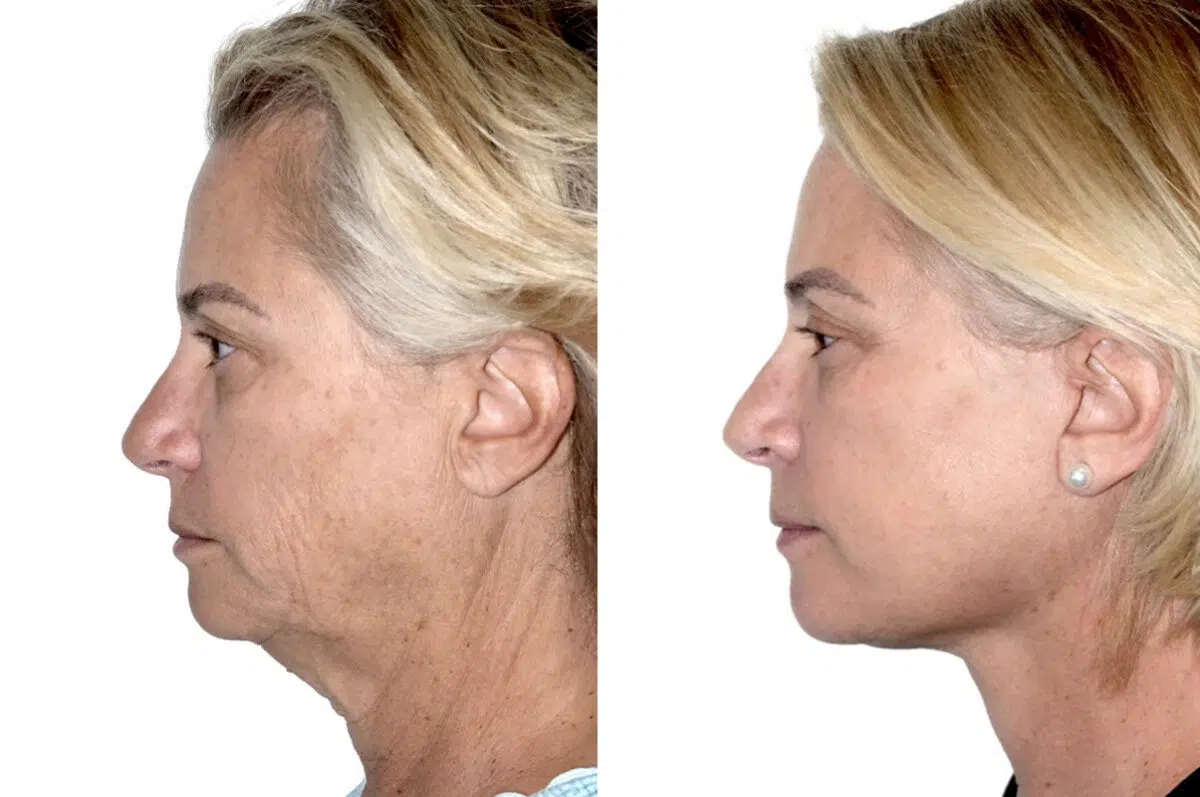 Deep Plane Facelift Before and After Photos in Miami, FL, Patient 30110