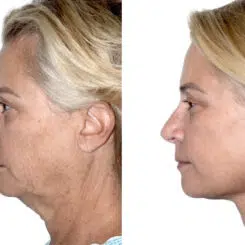 Deep Plane Facelift Before and After Photos in Miami, FL, Patient 30110