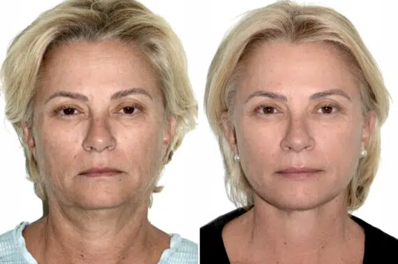 Deep Plane Facelift Before and After Photos in Miami, FL, Patient 30110