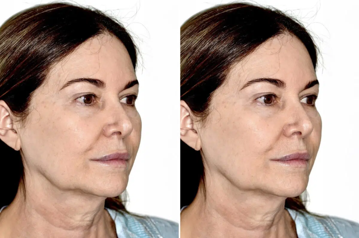 Deep Plane Facelift Before and After Photos in Miami, FL, Patient 30123