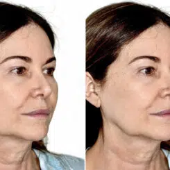 Deep Plane Facelift Before and After Photos in Miami, FL, Patient 30123