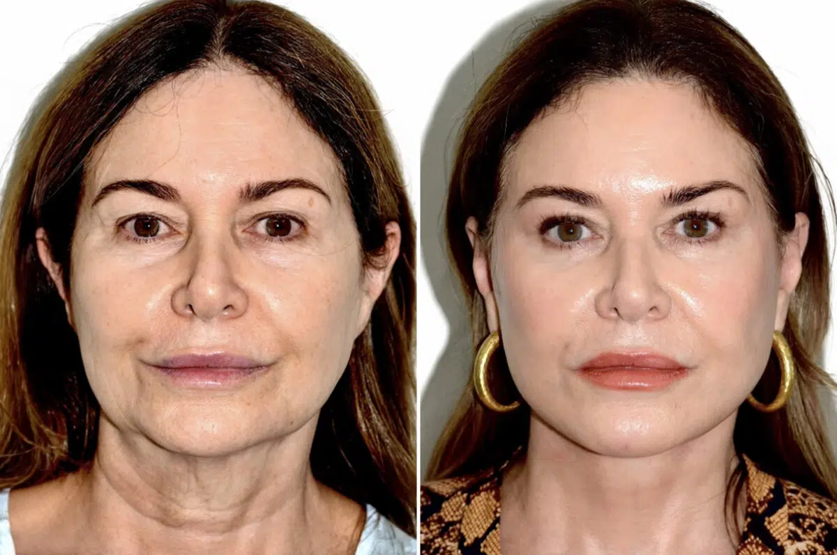Deep Plane Facelift Before and After Photos in Miami, FL, Patient 30123