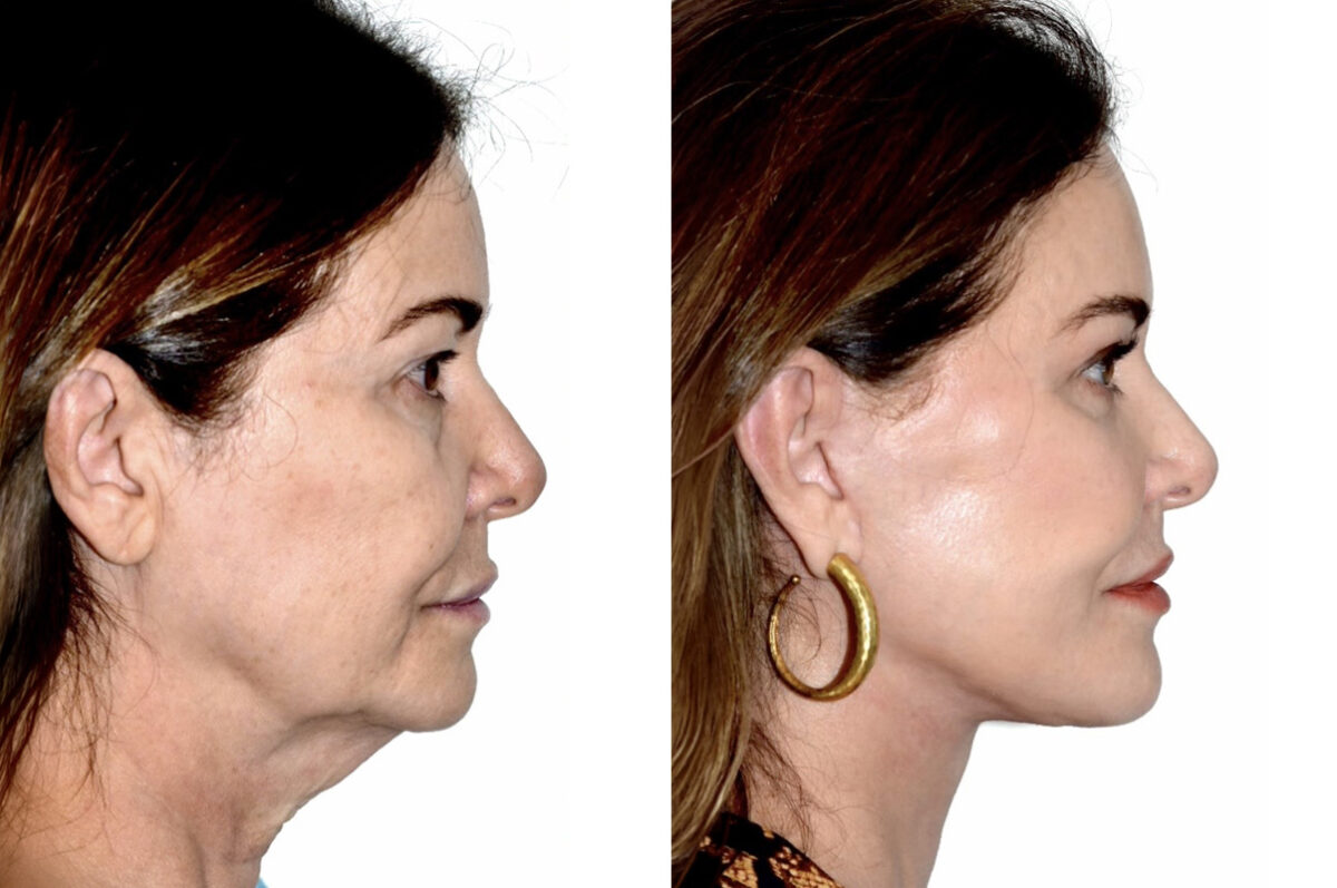 Deep Plane Facelift Before and After Photos in Miami, FL, Patient 30123
