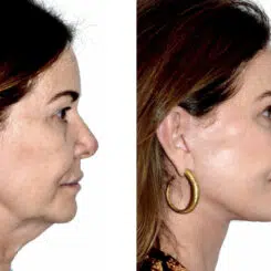Deep Plane Facelift Before and After Photos in Miami, FL, Patient 30123