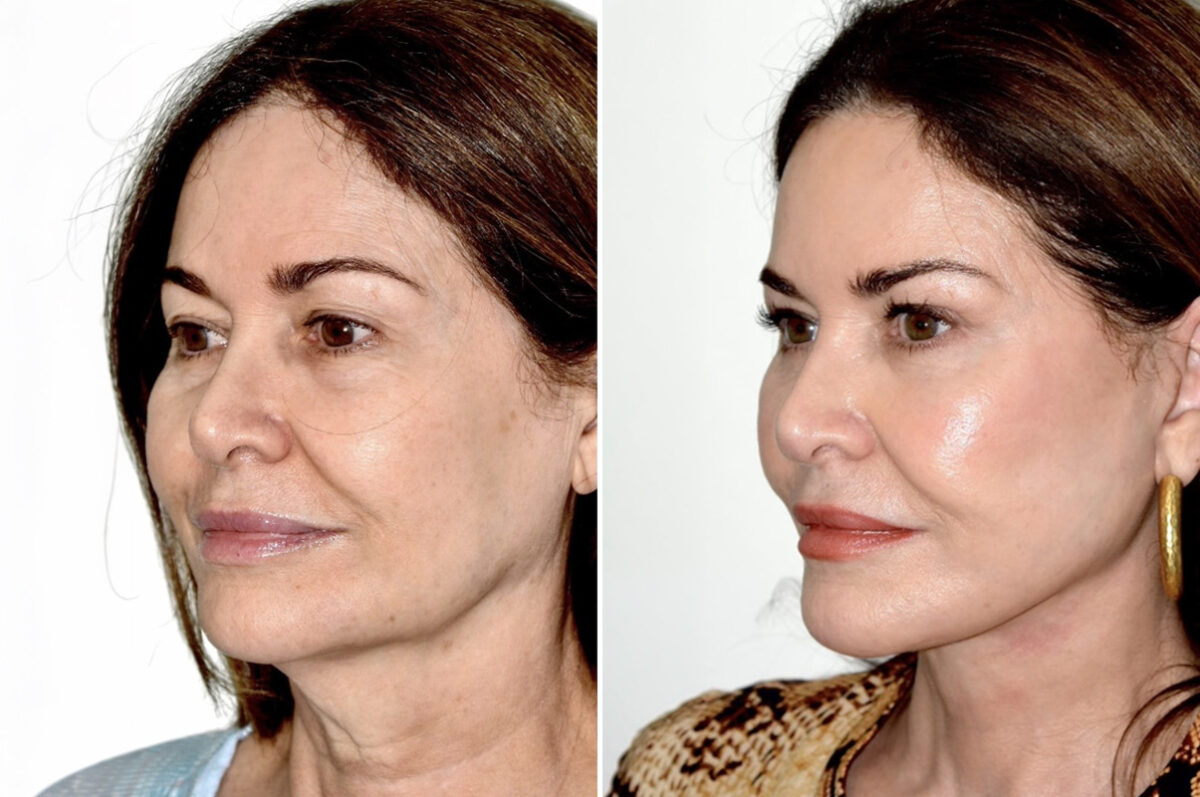 Deep Plane Facelift Before and After Photos in Miami, FL, Patient 30123