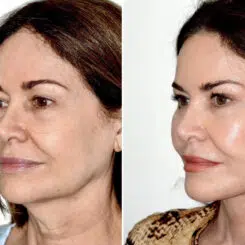 Deep Plane Facelift Before and After Photos in Miami, FL, Patient 30123