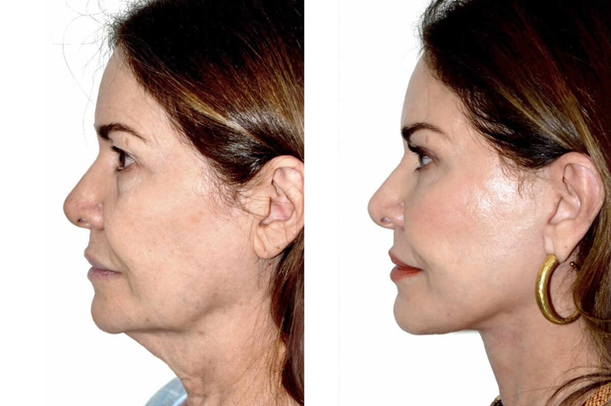 Deep Plane Facelift Before and After Photos in Miami, FL, Patient 30123