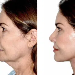 Deep Plane Facelift Before and After Photos in Miami, FL, Patient 30123