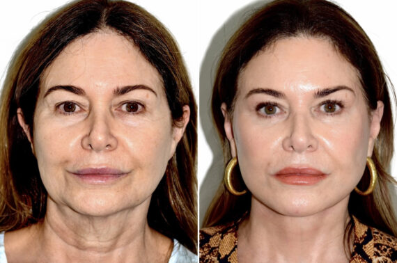Deep Plane Facelift Before and After Photos in Miami, FL, Patient 30123