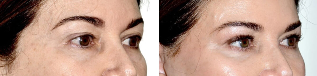 Blepharoplasty (eyelids) Before and After Photos in Miami, FL, Patient 30139