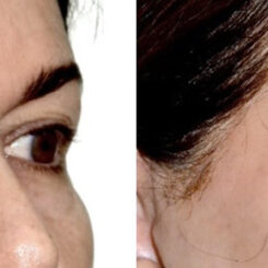 Blepharoplasty (eyelids) Before and After Photos in Miami, FL, Patient 30139