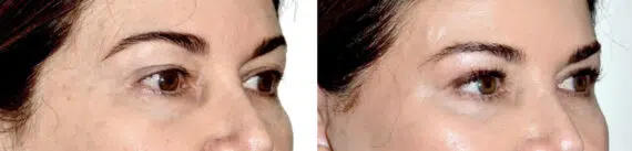 Blepharoplasty (eyelids) Before and After Photos in Miami, FL, Patient 30139