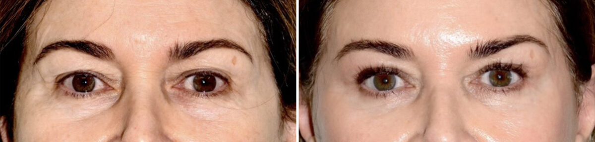 Blepharoplasty (eyelids) Before and After Photos in Miami, FL, Patient 30139