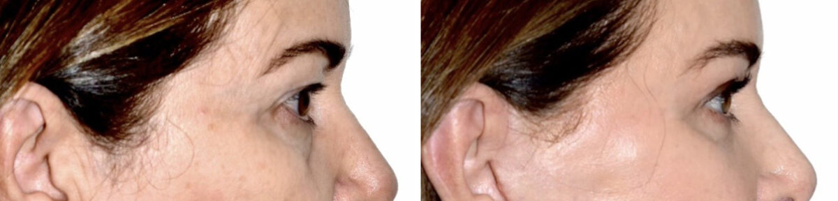 Blepharoplasty (eyelids) Before and After Photos in Miami, FL, Patient 30139