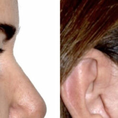 Blepharoplasty (eyelids) Before and After Photos in Miami, FL, Patient 30139