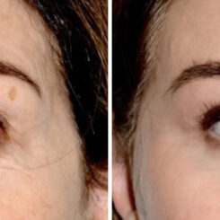 Blepharoplasty (eyelids) Before and After Photos in Miami, FL, Patient 30139