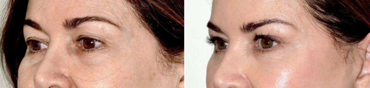 Blepharoplasty (eyelids) Before and After Photos in Miami, FL, Patient 30139