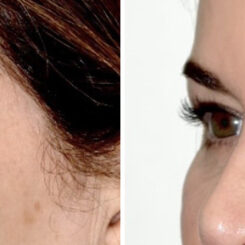 Blepharoplasty (eyelids) Before and After Photos in Miami, FL, Patient 30139