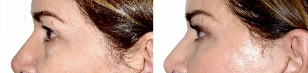 Blepharoplasty (eyelids) Before and After Photos in Miami, FL, Patient 30139
