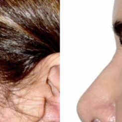 Blepharoplasty (eyelids) Before and After Photos in Miami, FL, Patient 30139