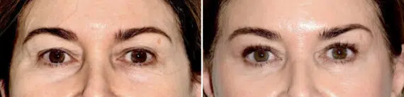 Blepharoplasty (eyelids) Before and After Photos in Miami, FL, Patient 30139