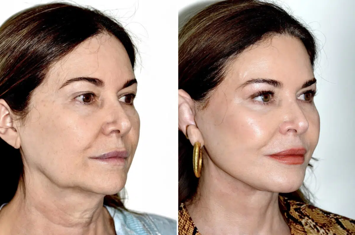 Deep Plane Facelift Before and After Photos in Miami, FL, Patient 30123